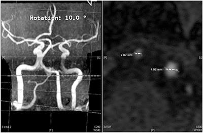 Vertebral artery hypoplasia and hemodynamic impairment in transient global amnesia: a case control study